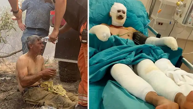 Yanıyorum Diye Feryat Eden Orman İşçisinin Tedavisi Devam Ediyor: Olayın Ardındaki Gerçekler