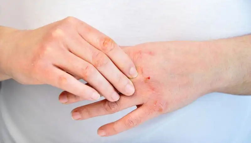 Yetersiz Protein Tüketiminin Altı Aşkın Belirtileri hakkında Bilmeniz Gerekenler