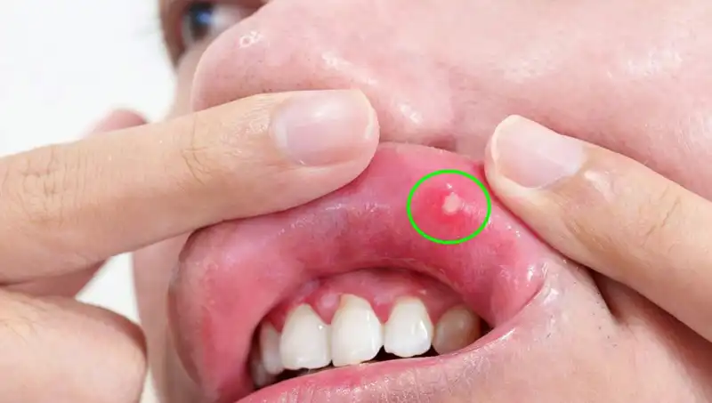 Kanserin Gizli Belirtilerine Dikkat! Dilini Kaybeden Adamın Hikayesi